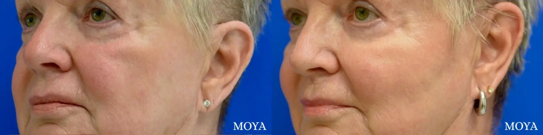 Fillers: Patient 8 - Before and After 2