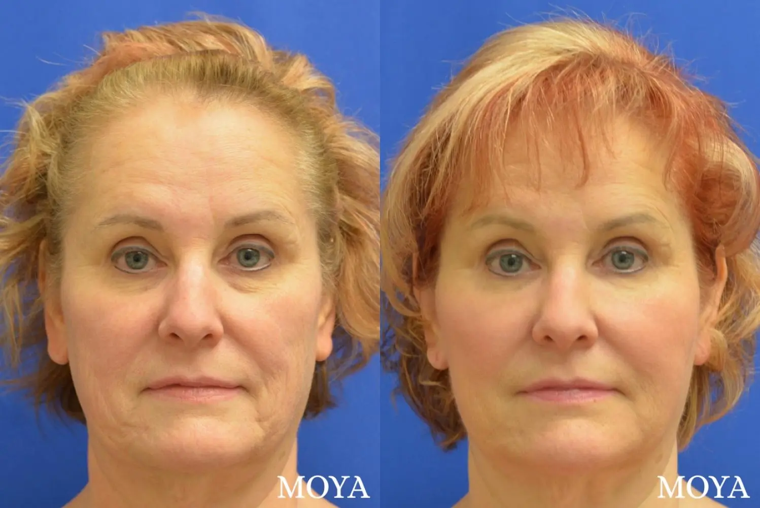 Fillers: Patient 12 - Before and After 1