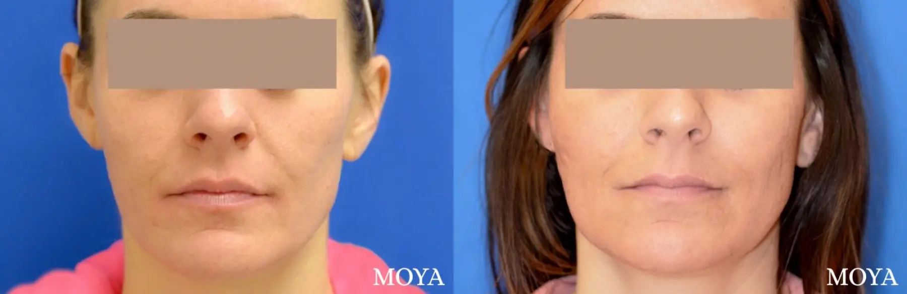 Fillers: Patient 14 - Before and After  