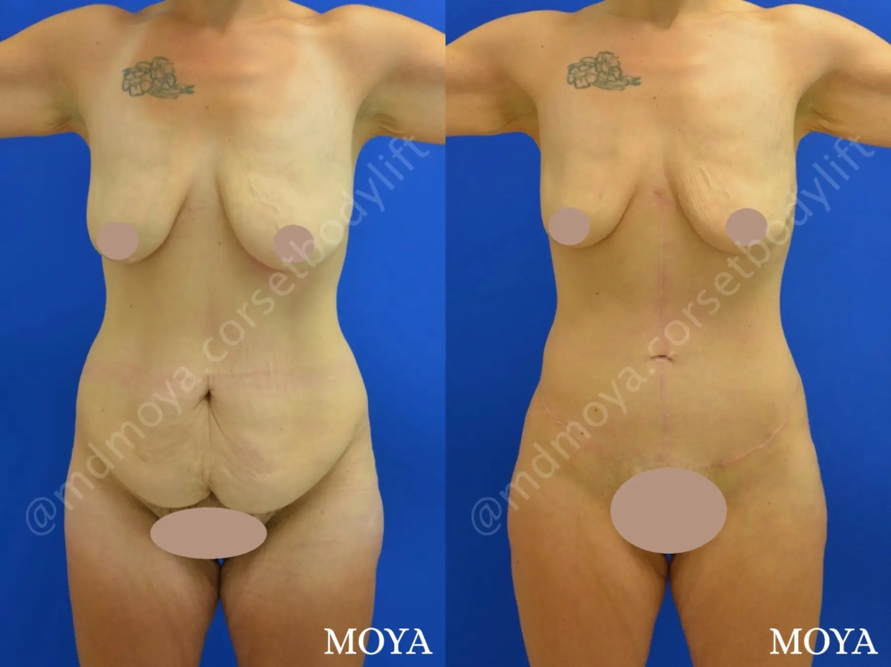 Fleur-de-lis Tummy Tuck (std):  BMI 24 - Before and After  