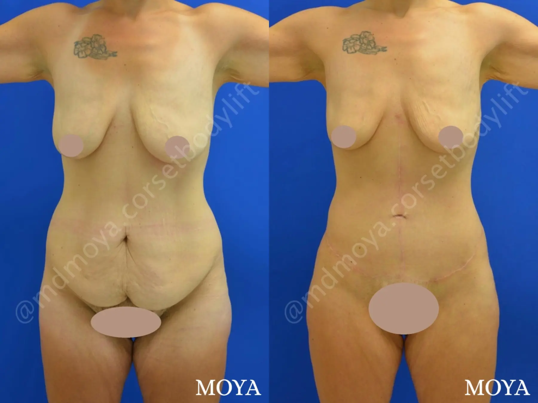 Before & After Abdominoplasty 24 Photos