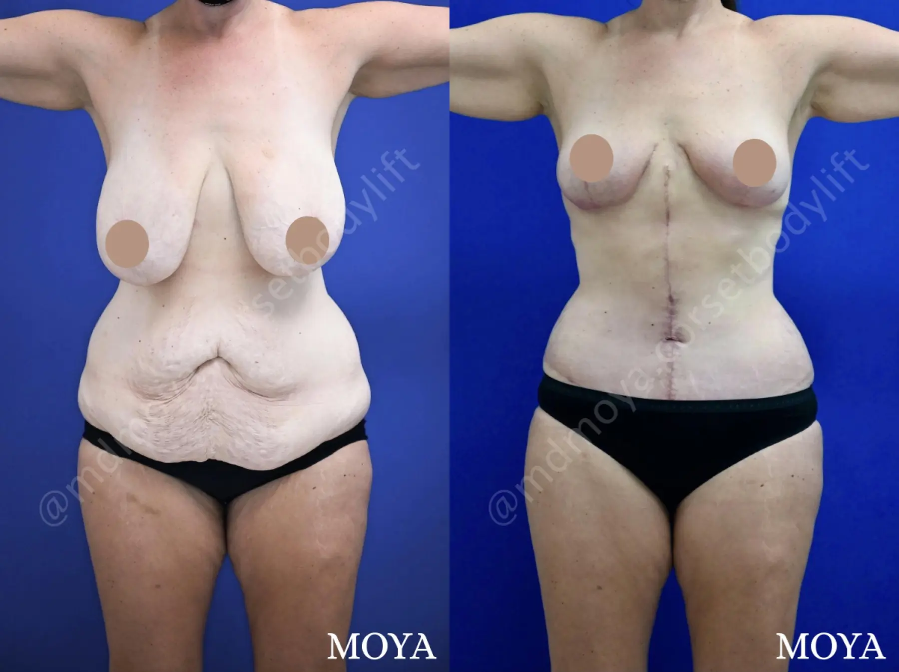 Fleur-de-lis Tummy Tuck (std):  BMI 28 - Before and After 1