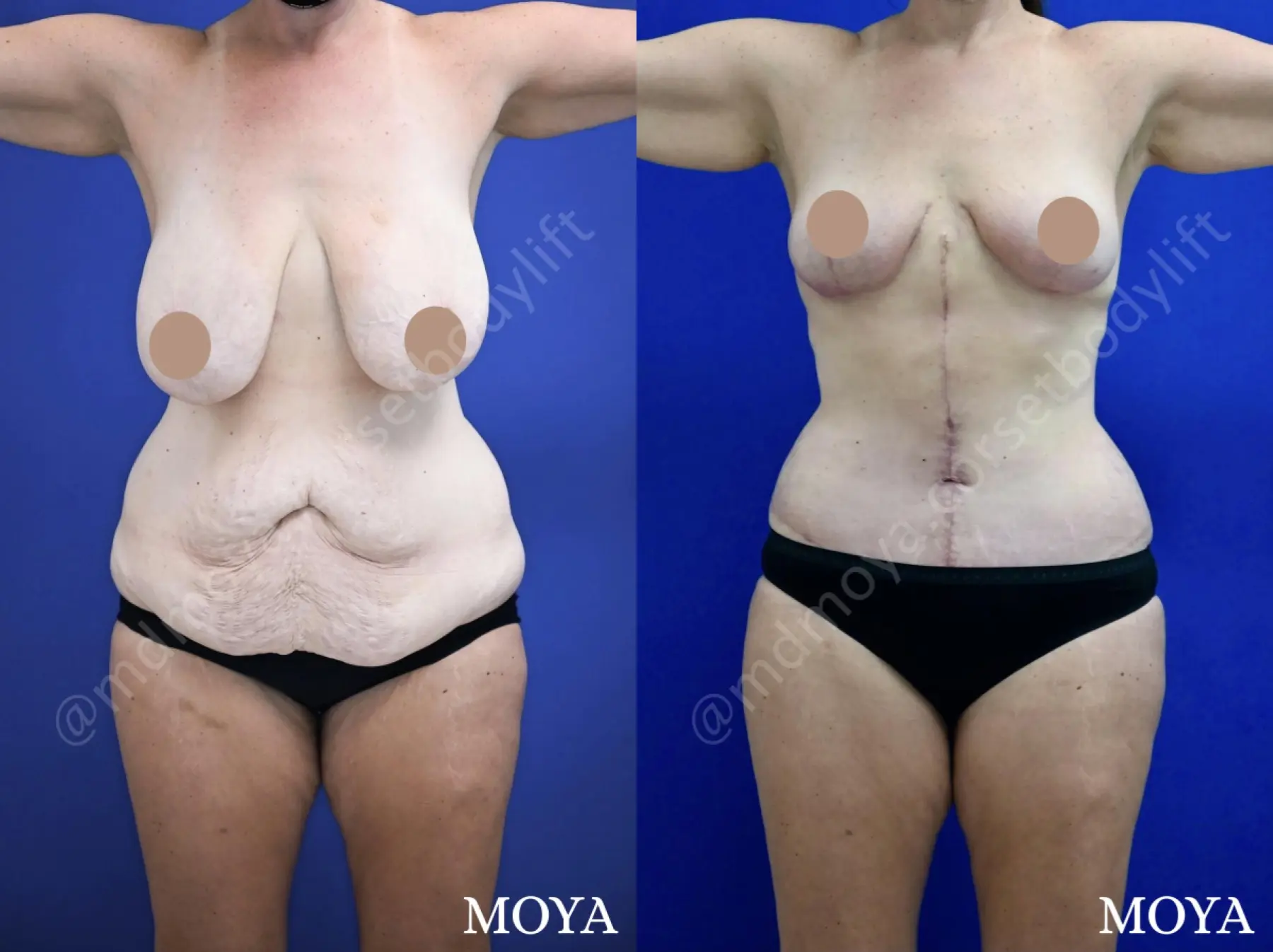 Tummy Tuck Lewisburg  Abdominoplasty Surgery in Near Me