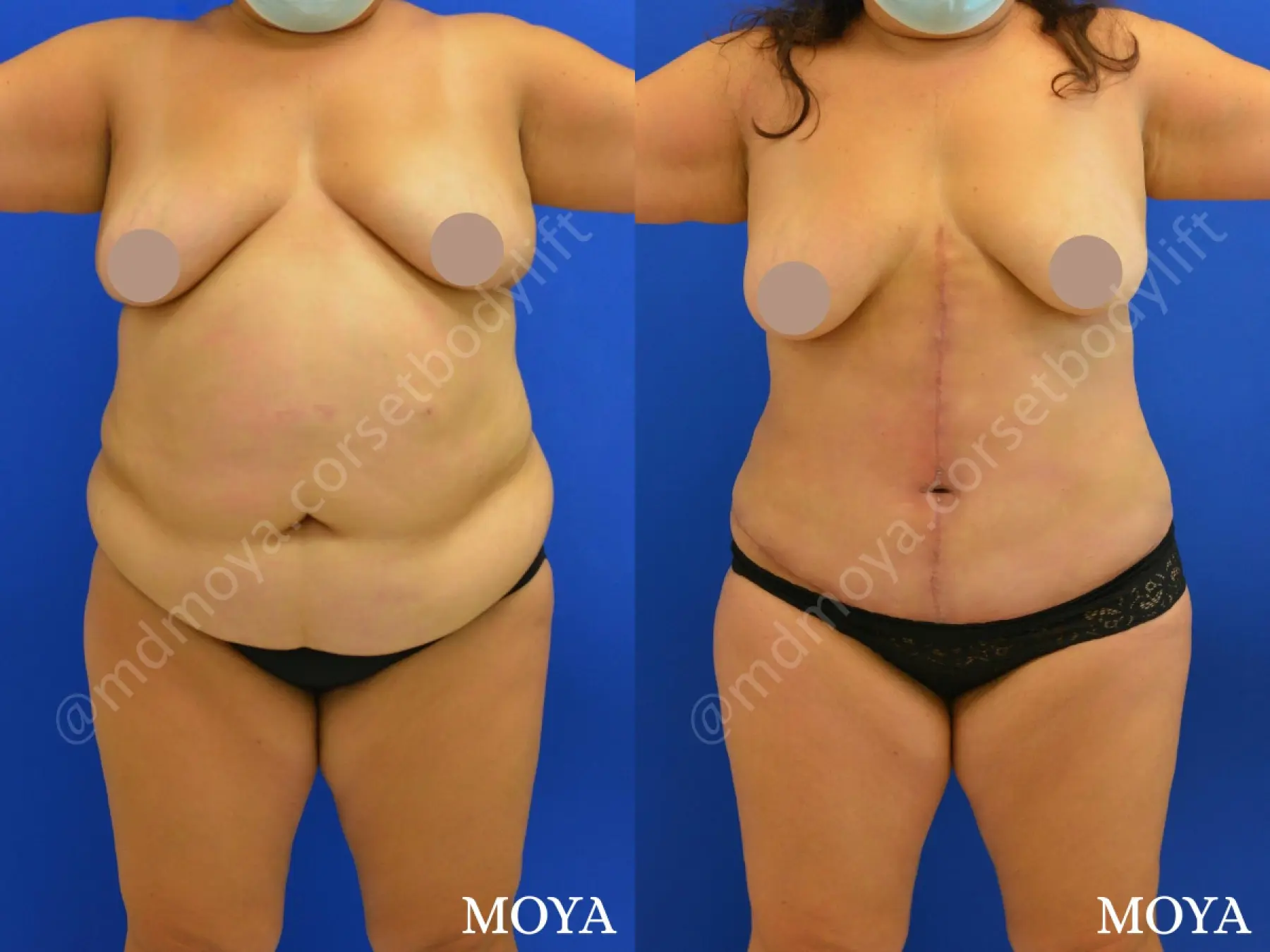 Fleur-de-lis Tummy Tuck (std):  BMI 32 - Before and After 1