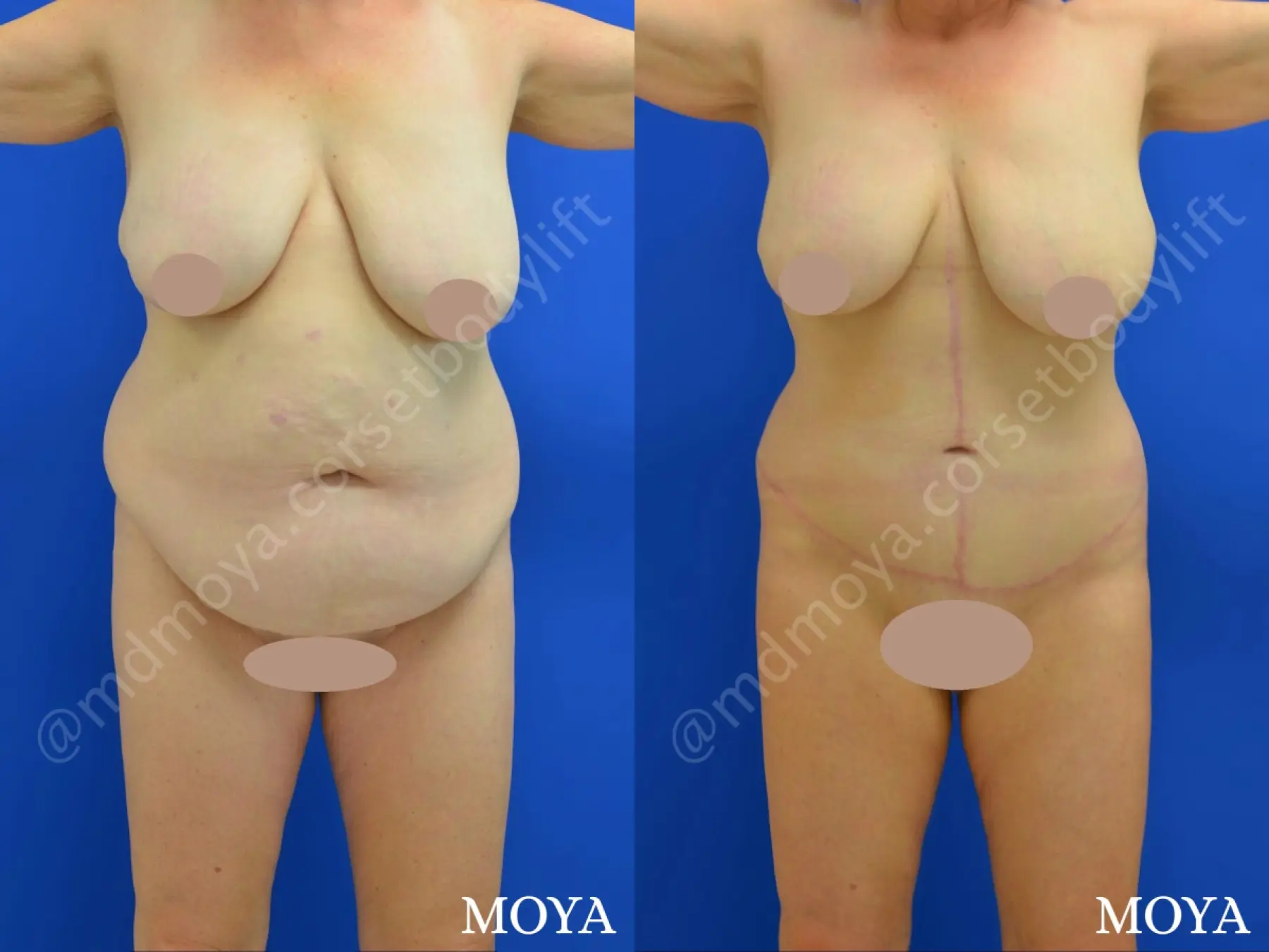 Fleur-de-lis Tummy Tuck (std):  BMI 28 - Before and After  