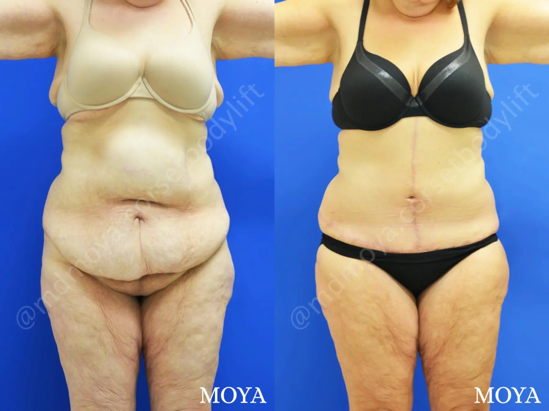 Fleur-de-lis Tummy Tuck (ltd):  BMI 34 - Before and After  