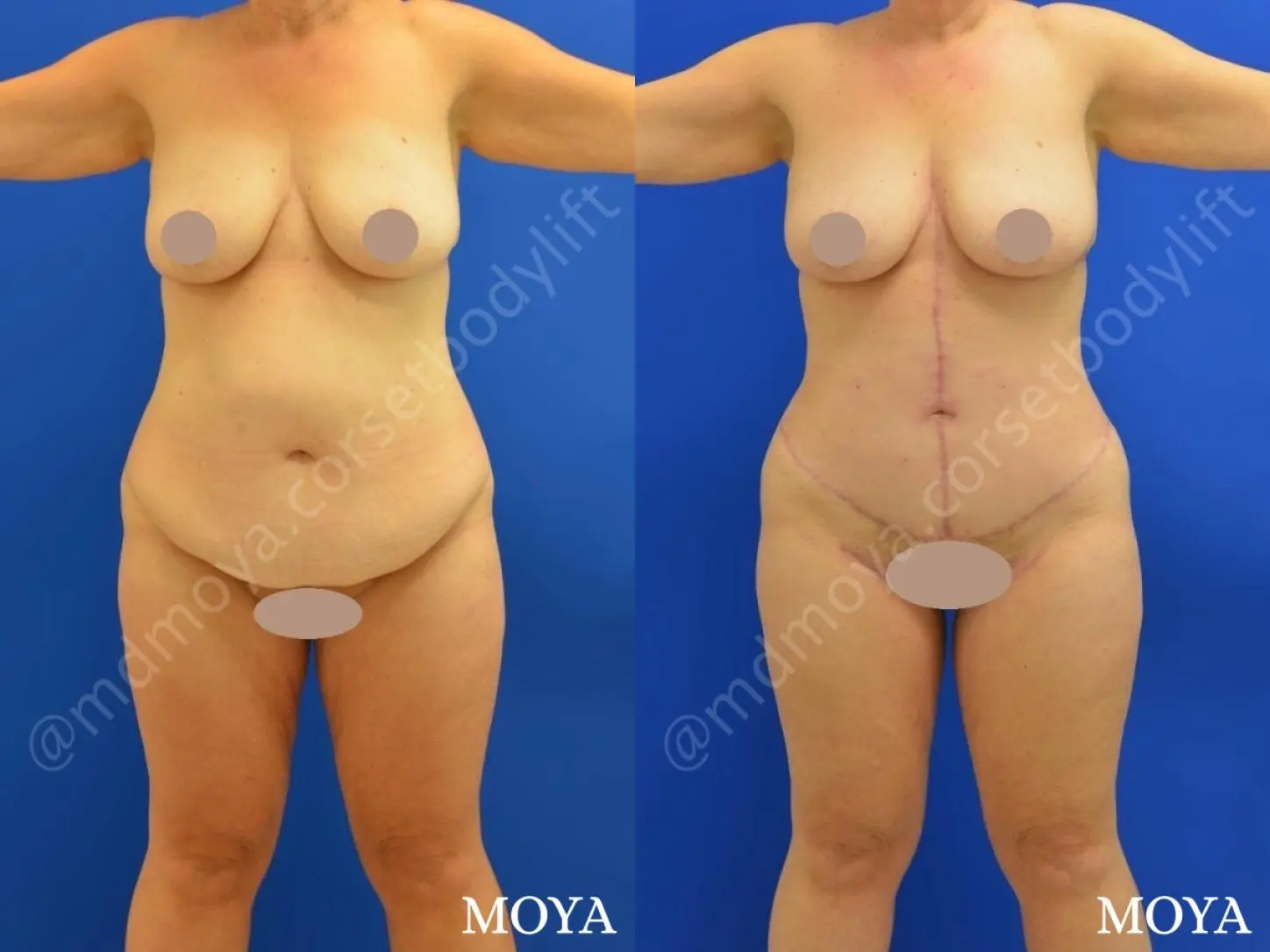 Fleur-de-lis Tummy Tuck (std):  BMI 29 - Before and After  