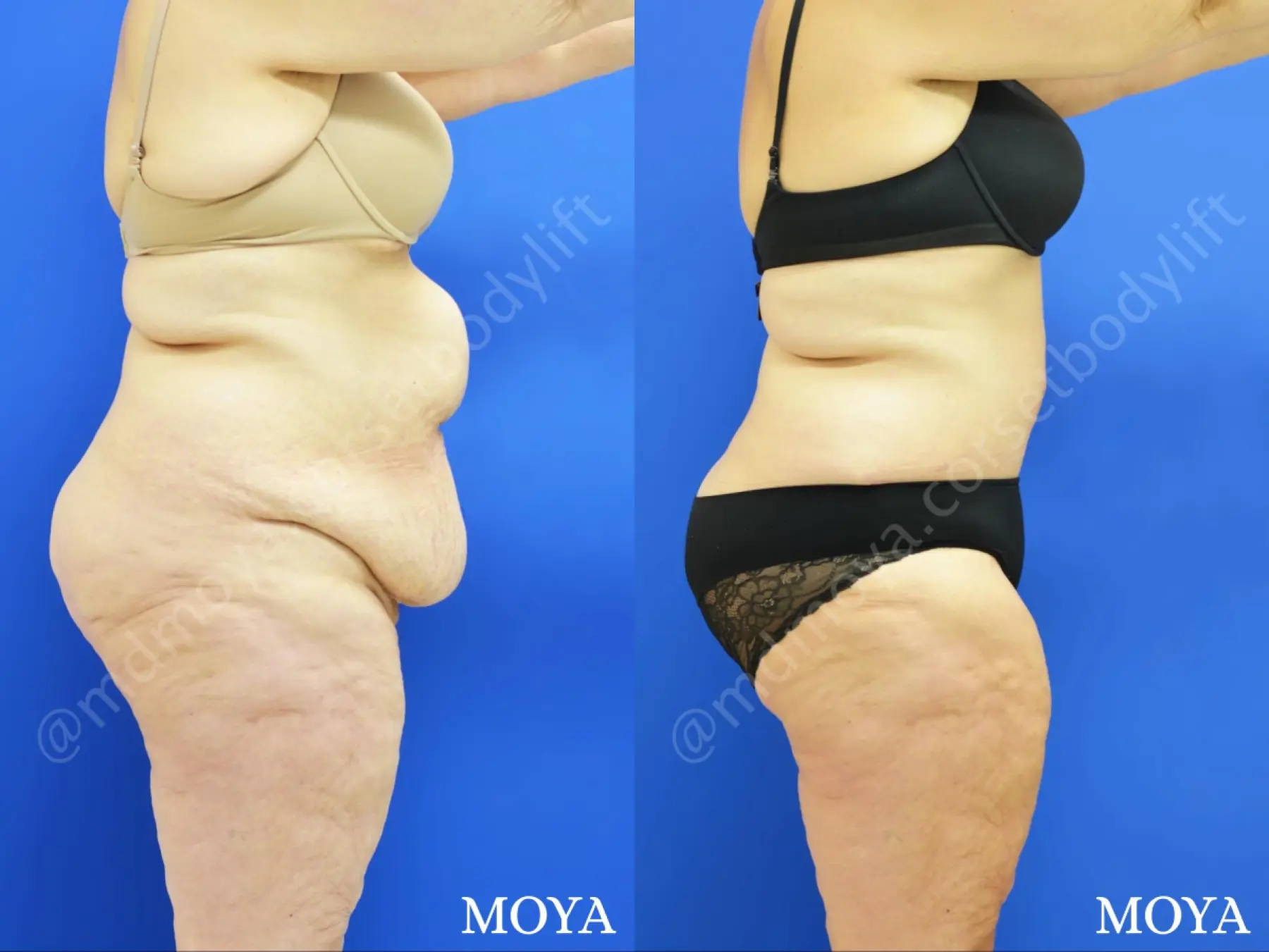 Fleur-de-lis Tummy Tuck (ltd):  BMI 34 - Before and After 2