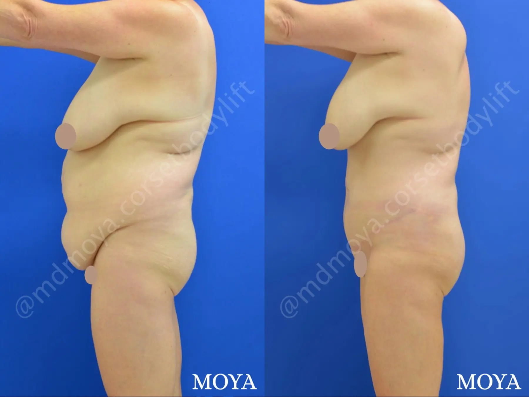 Fleur-de-lis Tummy Tuck (std):  BMI 28 - Before and After 2
