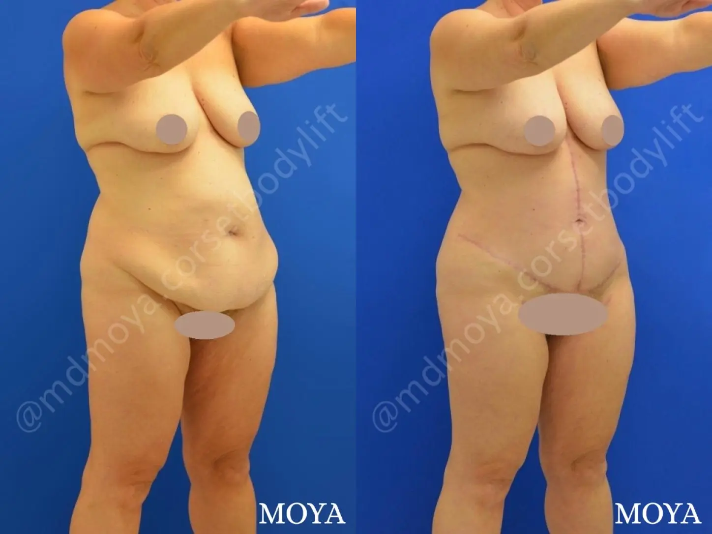 Fleur-de-lis Tummy Tuck (std):  BMI 29 - Before and After 2