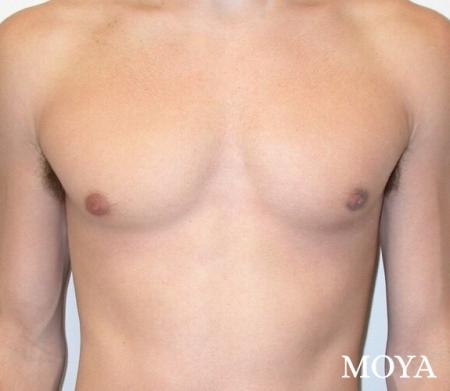 Male Breast Reduction: Patient 3 - After Image 2
