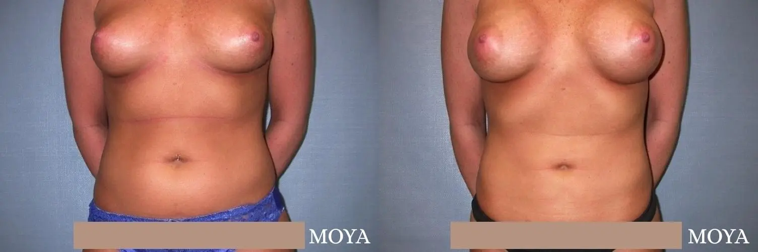 Liposuction (Abdomen):  Patient 1 - Before and After  
