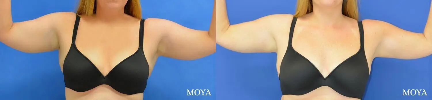 Liposuction (Arms):  Patient 1 - Before and After 2