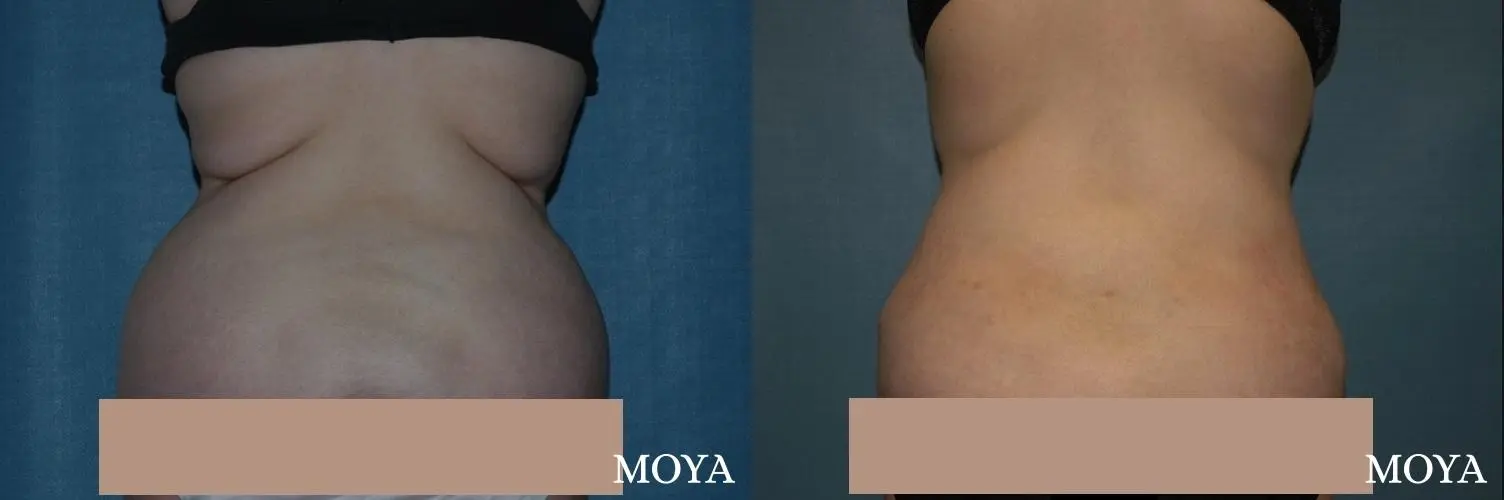 Liposuction - Back - Before and After 1