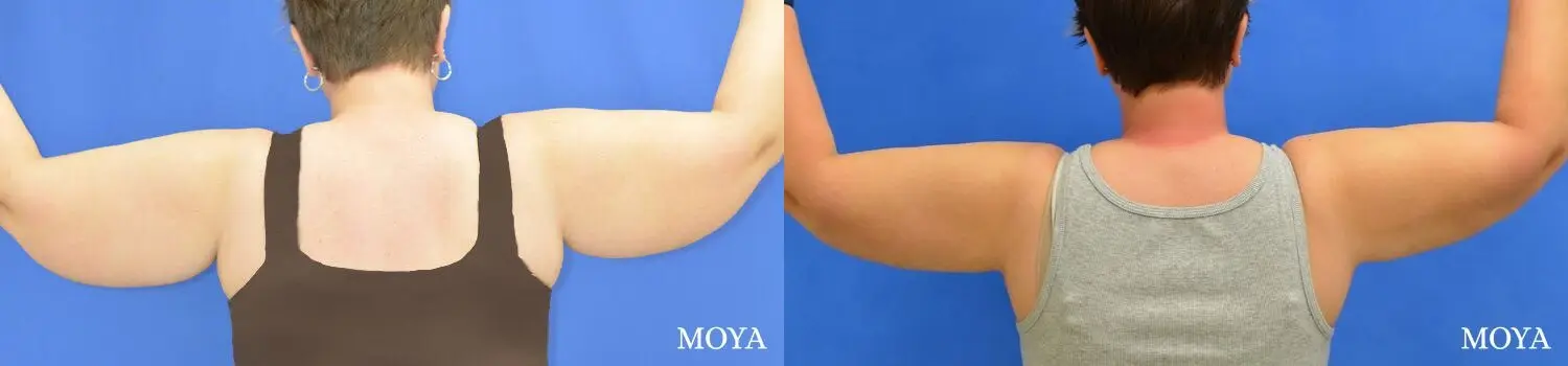 Liposuction (Arms):  Patient 2 - Before and After 2