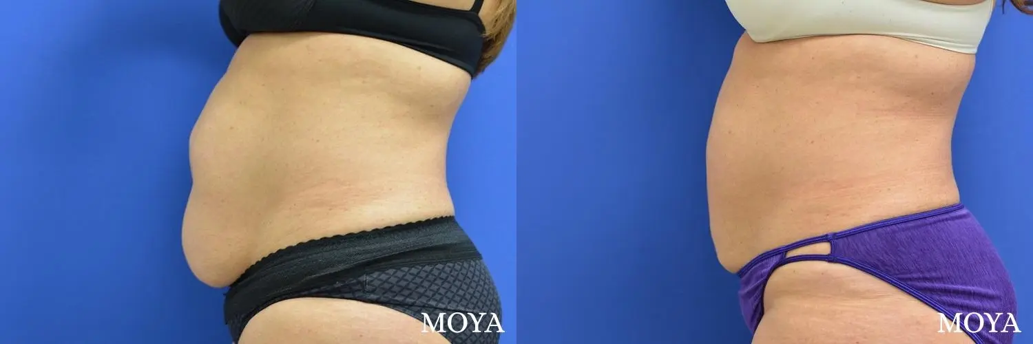 Liposuction - Abdomen - Before and After 2