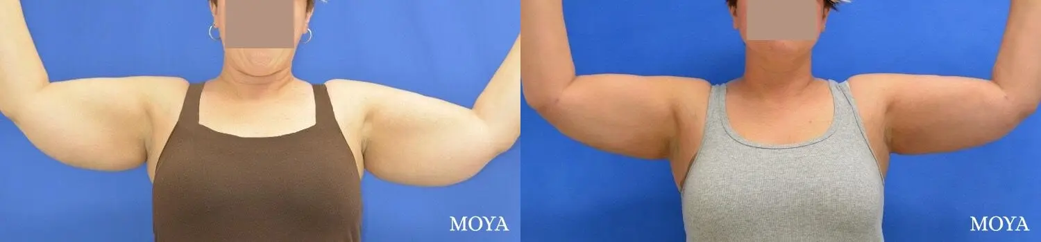 Liposuction (Arms):  Patient 2 - Before and After  