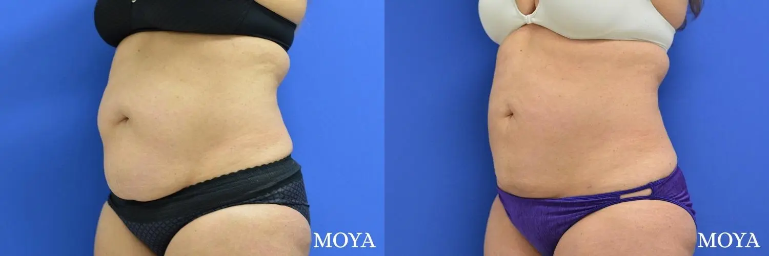 Liposuction - Abdomen - Before and After 1