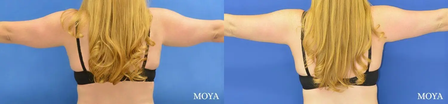 Liposuction (Arms):  Patient 1 - Before and After  