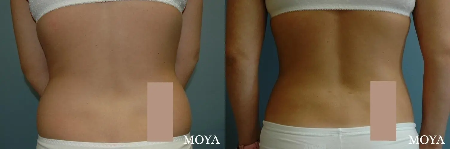 Liposuction - Back - Before and After 1