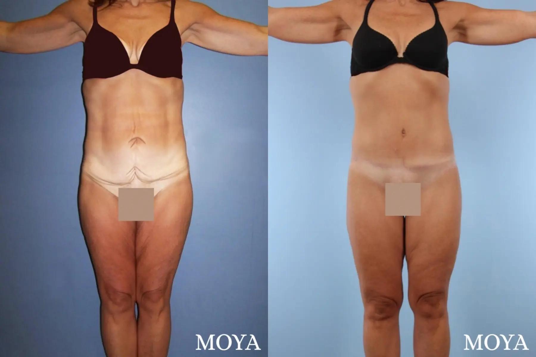 Lower Body Lift: Patient 1 - Before and After  