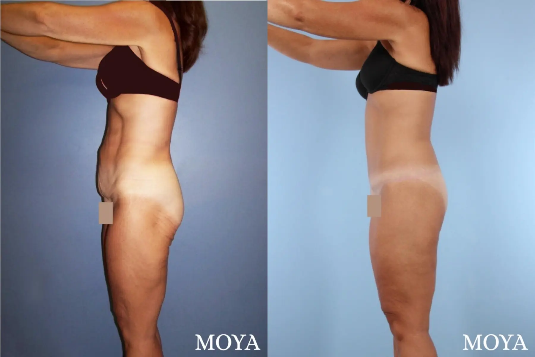Lower Body Lift: Patient 1 - Before and After 2