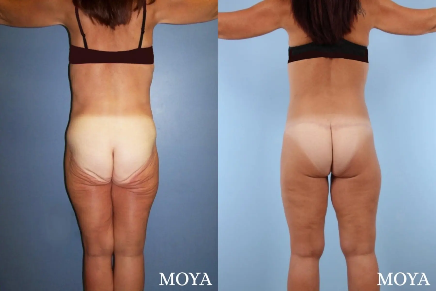 Lower Body Lift: Patient 1 - Before and After 3