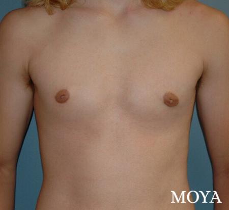 Male Breast Reduction: Patient 2 - After Image 2