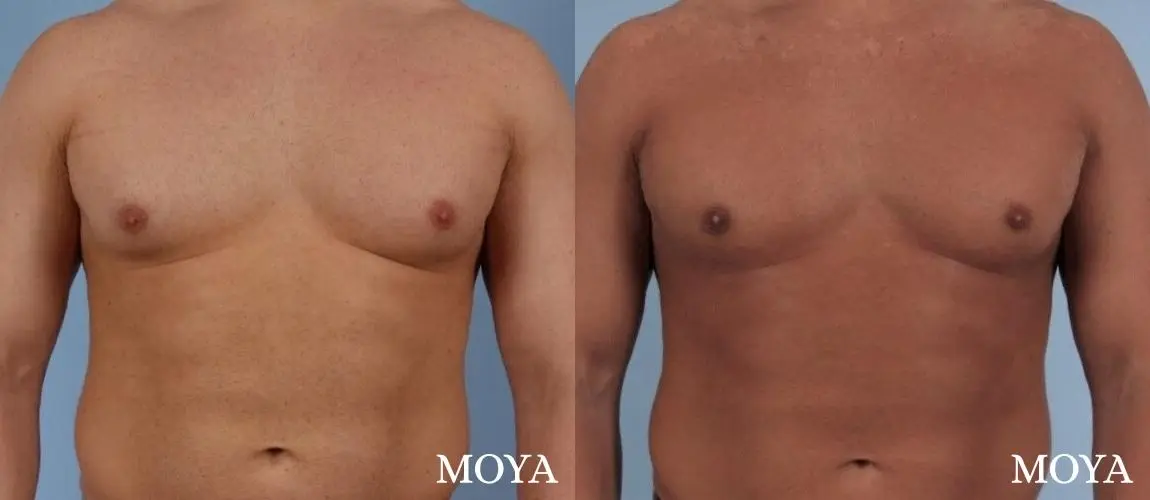 Male Breast Reduction: Patient 4 - Before and After 2