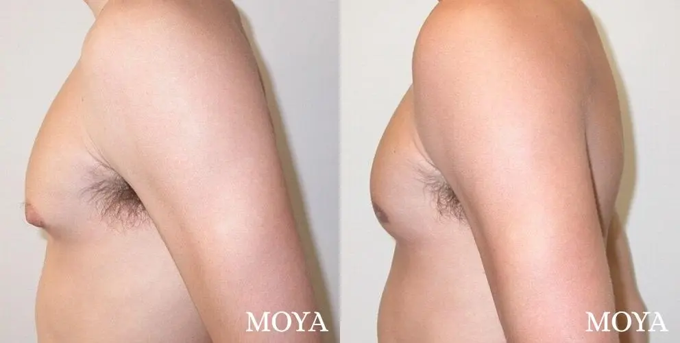 Male Breast Reduction: Patient 3 - Before and After 1