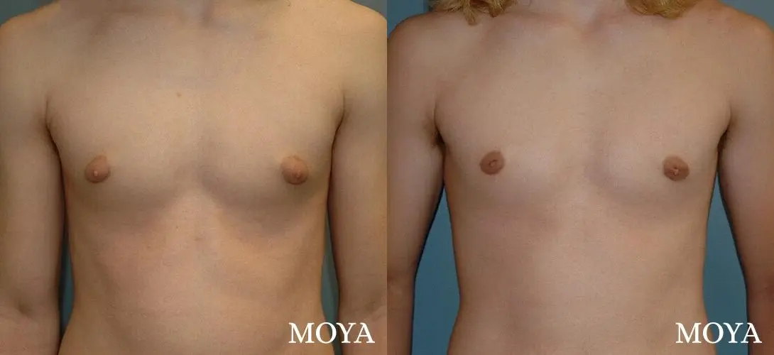 Male Breast Reduction: Patient 2 - Before and After 2