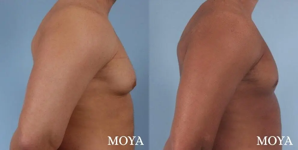 Male Breast Reduction: Patient 4 - Before and After 1