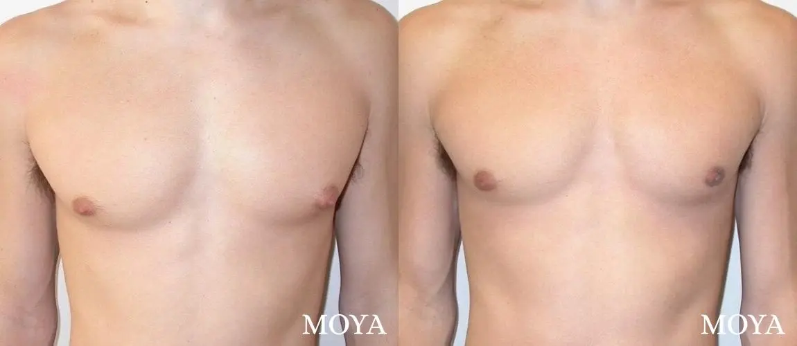 Male Breast Reduction: Patient 3 - Before and After 2