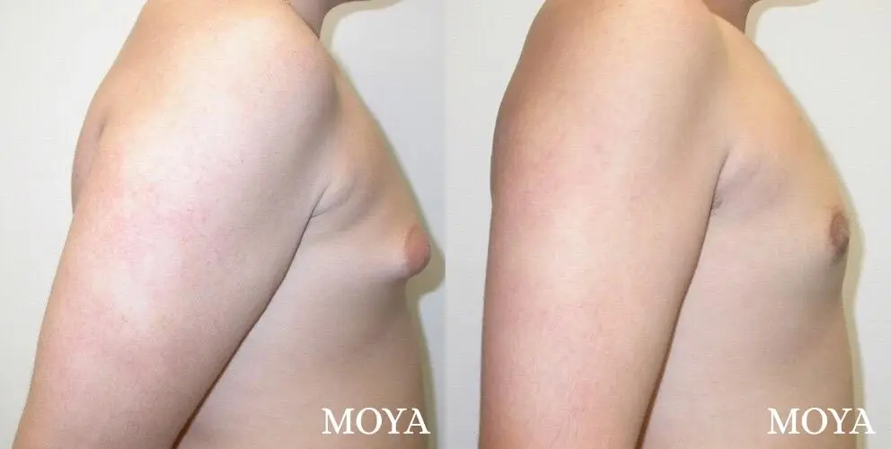 Male Breast Reduction: Patient 1 - Before and After 1