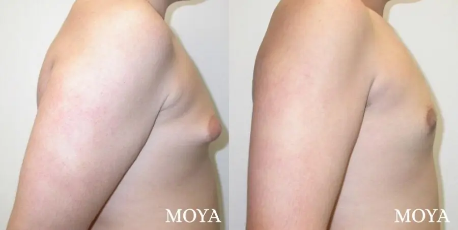 Male Breast Reduction: Patient 1 - Before and After  