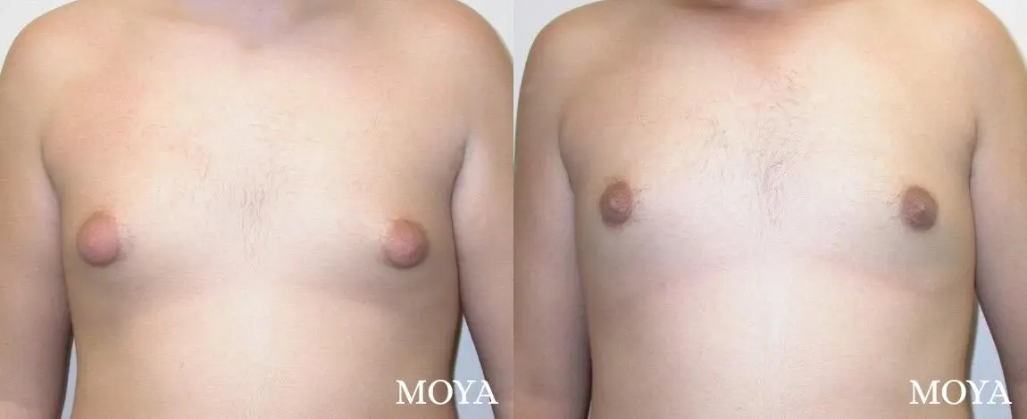 Male Breast Reduction: Patient 1 - Before and After 2