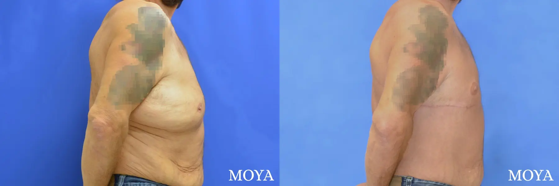 Upper Body Lift: Patient 4 - Before and After  