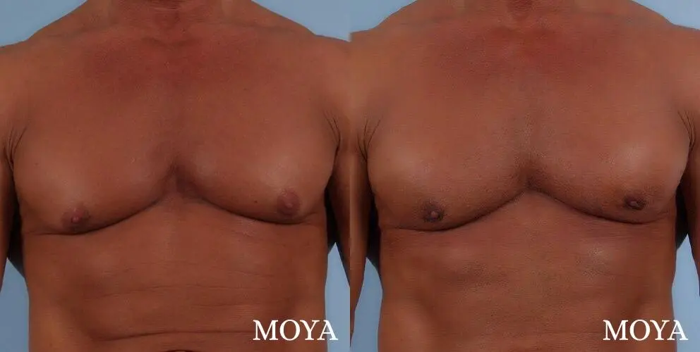 Male Breast Reduction: Patient 5 - Before and After 2
