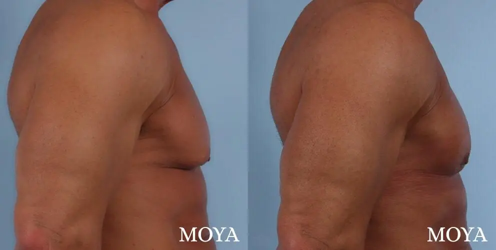 Male Breast Reduction: Patient 5 - Before and After 1