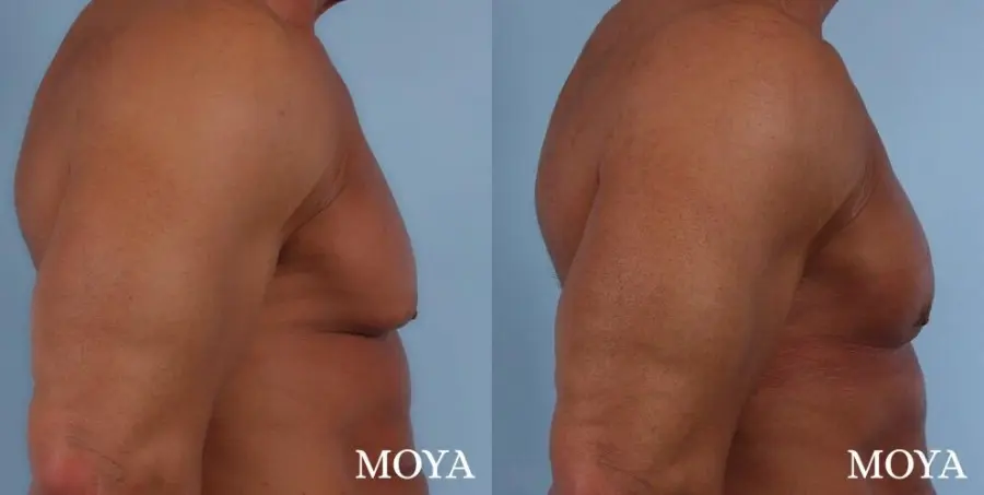 Male Breast Reduction: Patient 5 - Before and After  