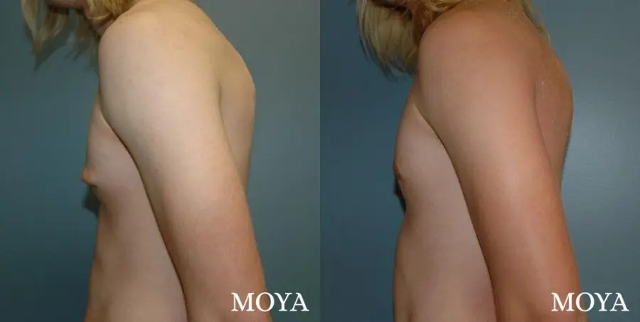 Male Breast Reduction: Patient 2 - Before and After  