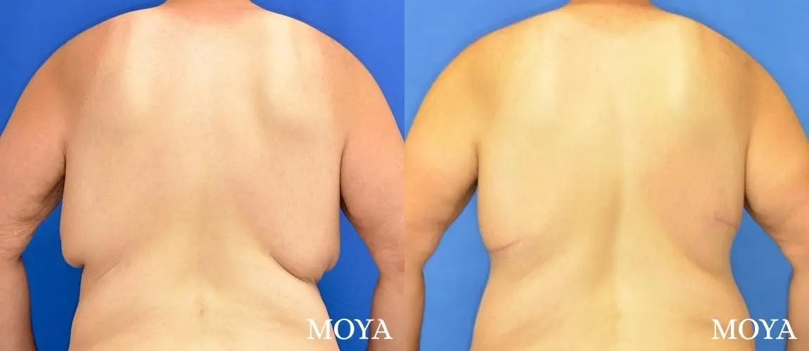 Male Upper Body Lift: Patient 2 - Before and After 3