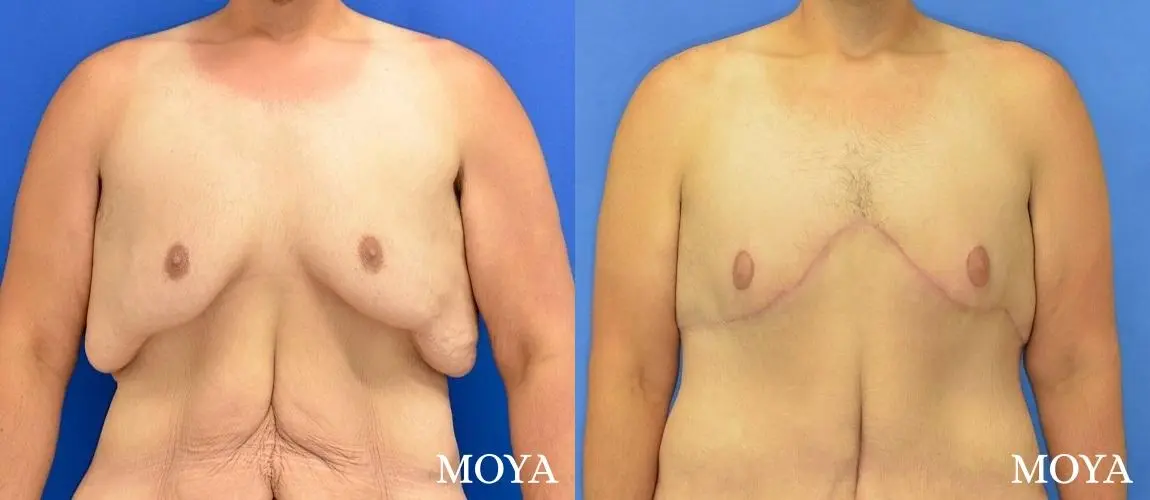 Male Upper Body Lift: Patient 2 - Before and After 1