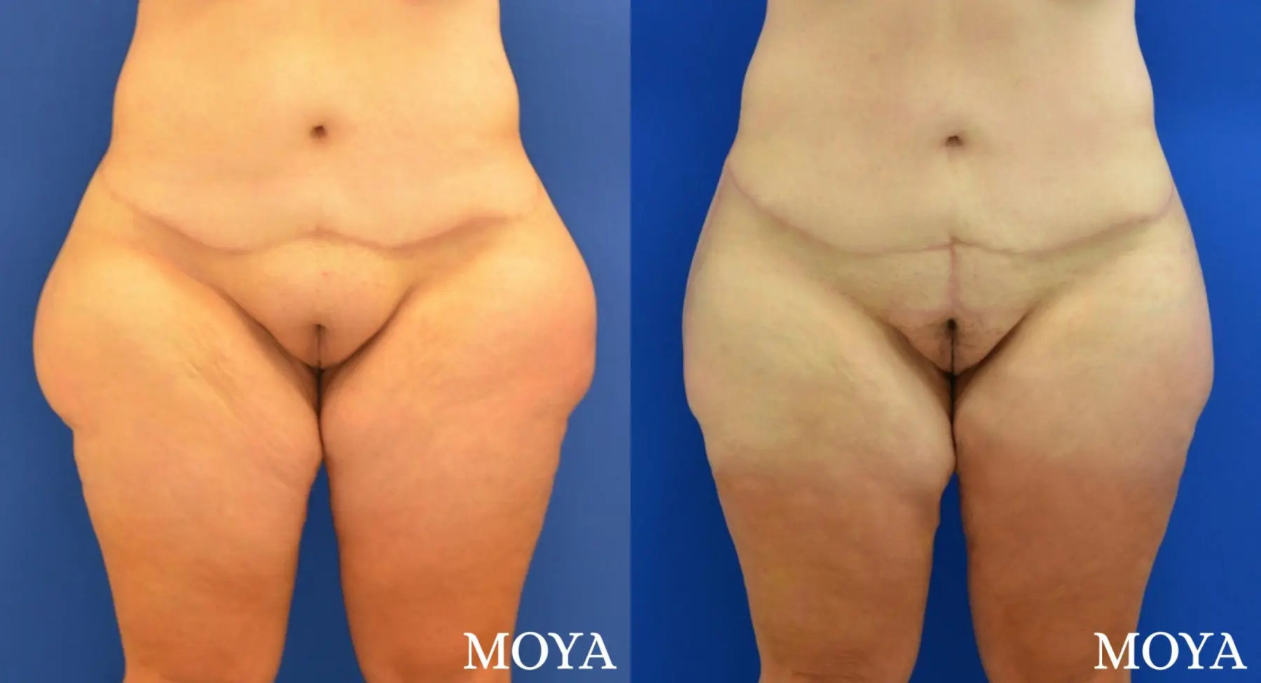 Mons Pubis Reduction: Patient 1 - Before and After 1