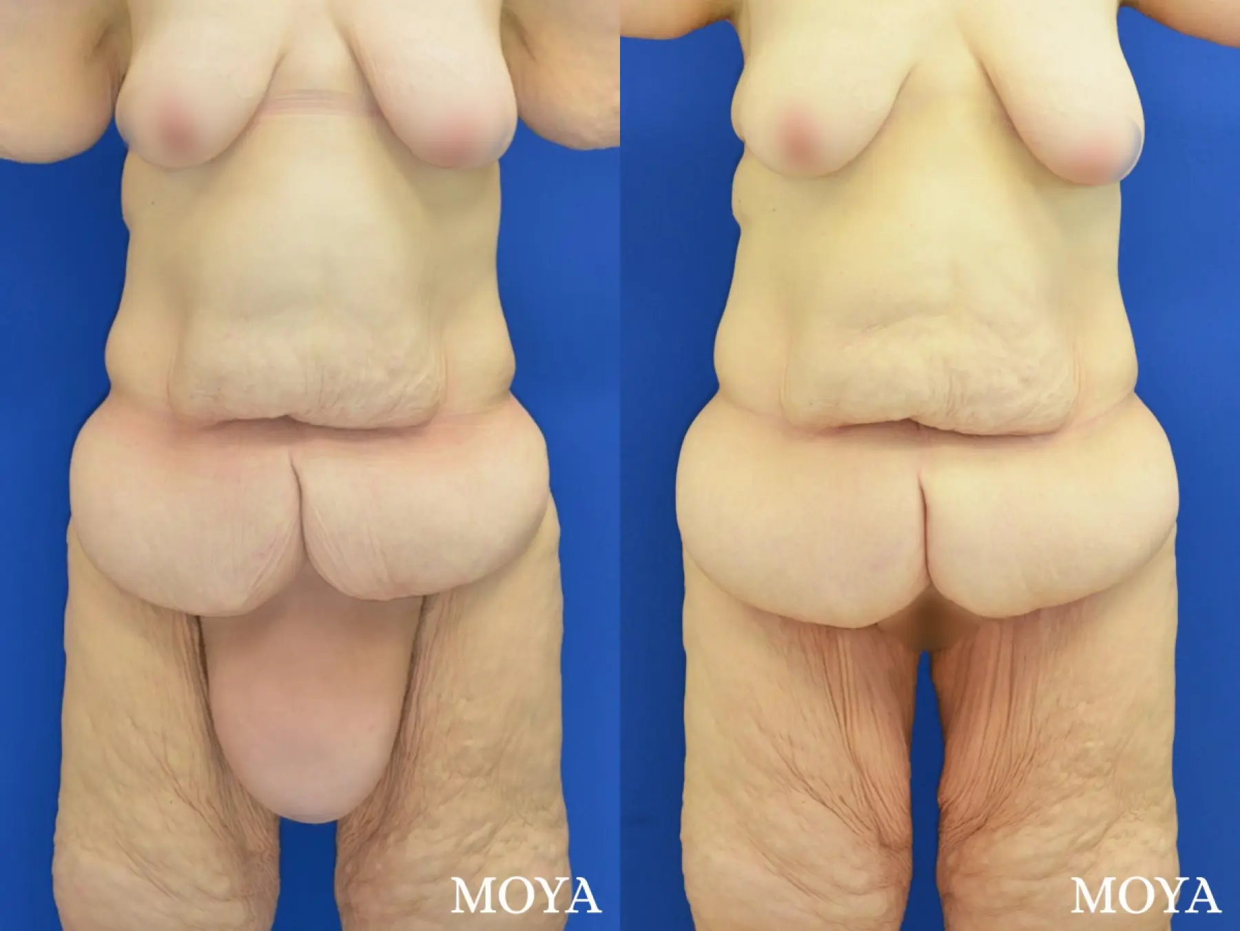 Mons Pubis Reduction: Patient 2 - Before and After 1