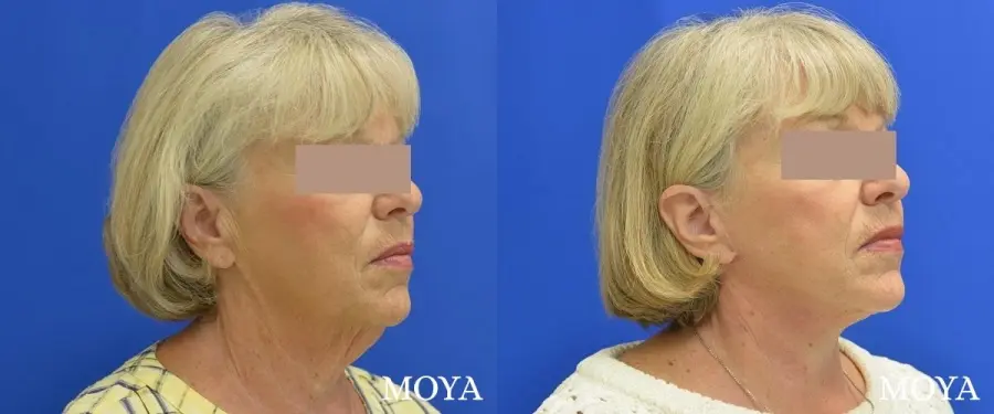Neck Lift: Patient 5 - Before and After  
