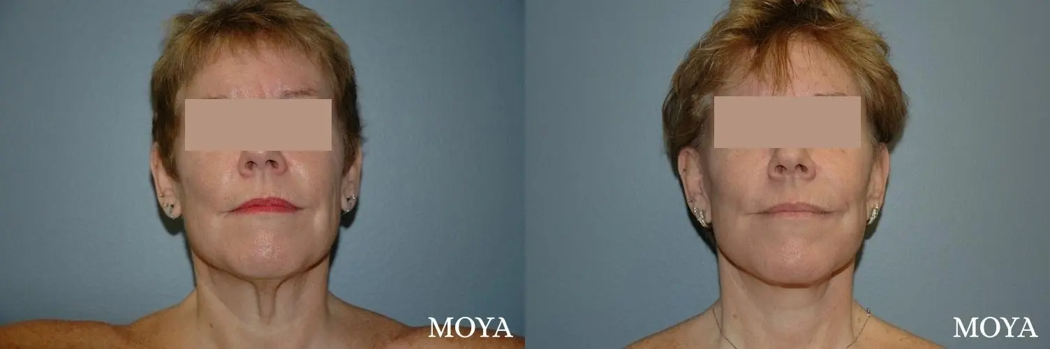 Neck Lift: Patient 2 - Before and After 1