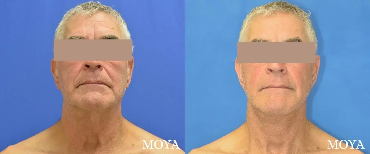 Neck Lift: Patient 4 - Before and After 1