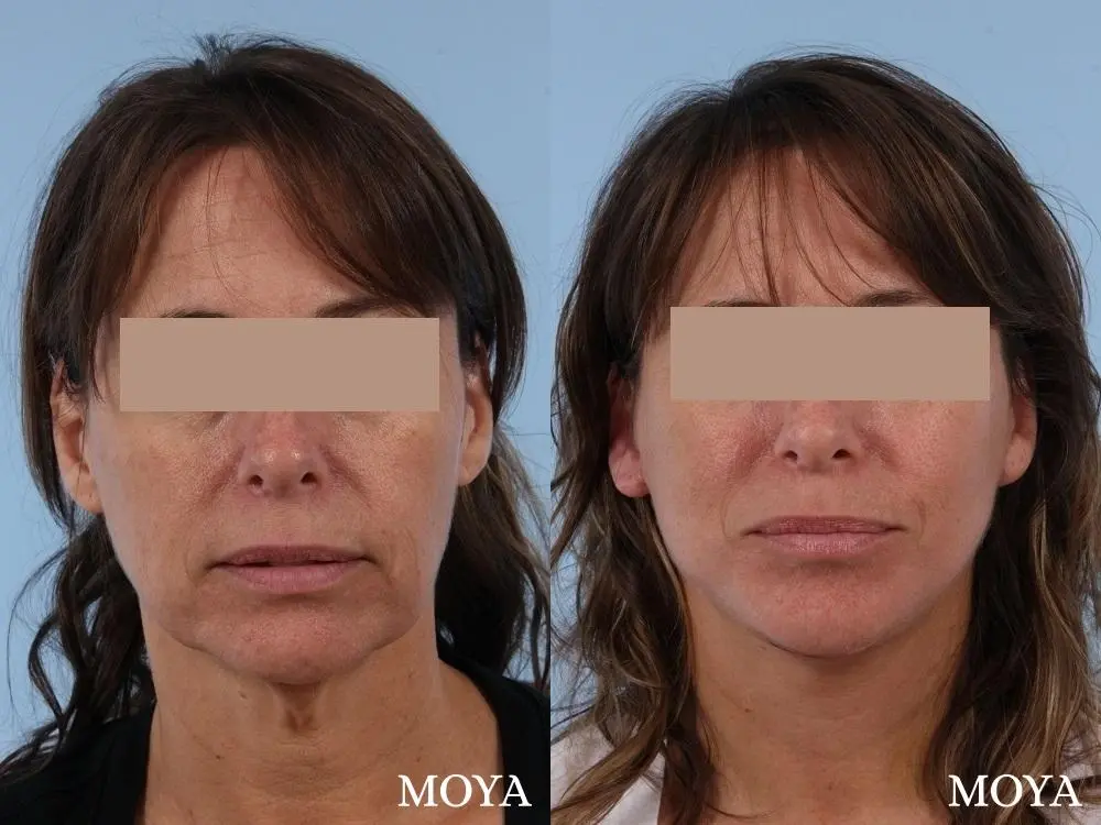 Neck Lift: Patient 1 - Before and After  