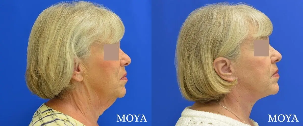 Neck Lift: Patient 5 - Before and After 2